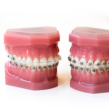 Kieferorthopädie Erwachsenenalter